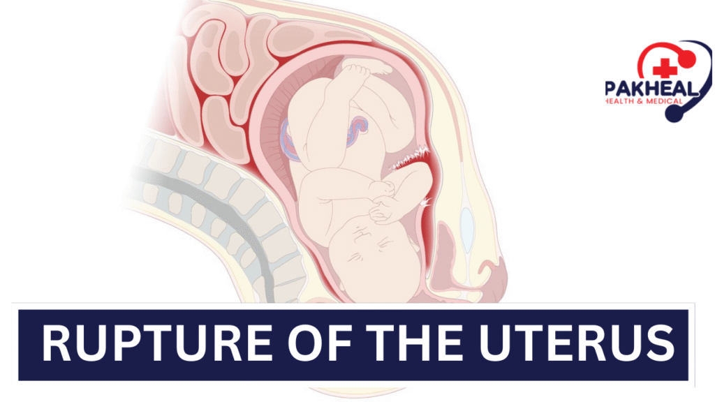 An image of a rupture of the uterus