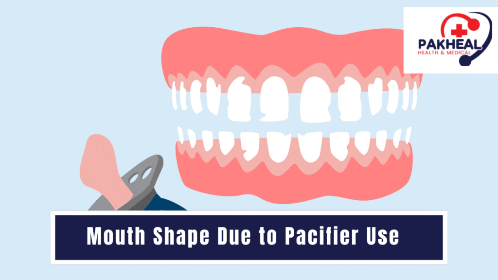 An image of mouth shape due to pacifier use