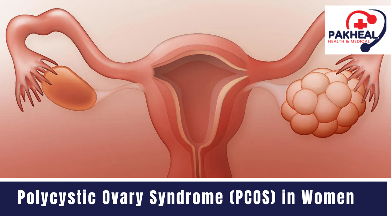 an image of Polycystic Ovary Syndrome (PCOS) in Women