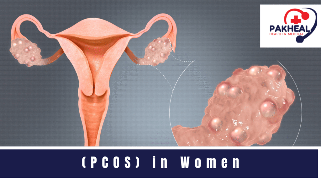 an image of Polycystic Ovary Syndrome (PCOS) in Women