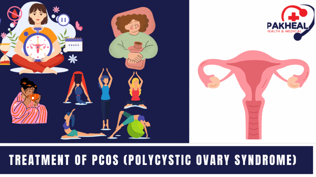 an image of the treatment of PCOS (Polycystic Ovary Syndrome)