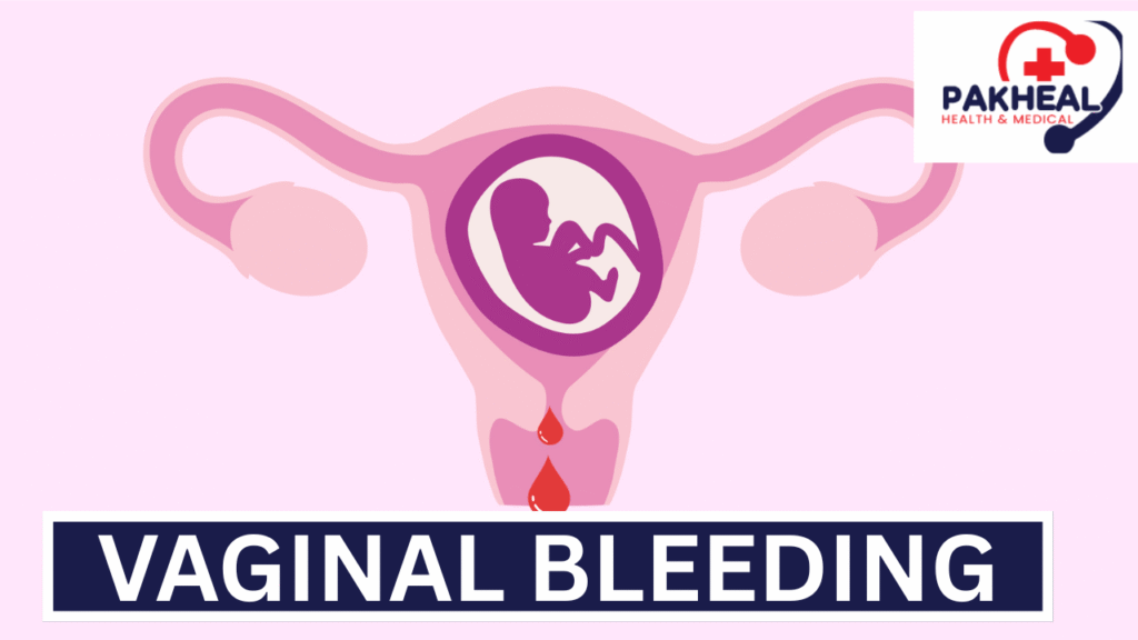 An image of Vaginal bleeding