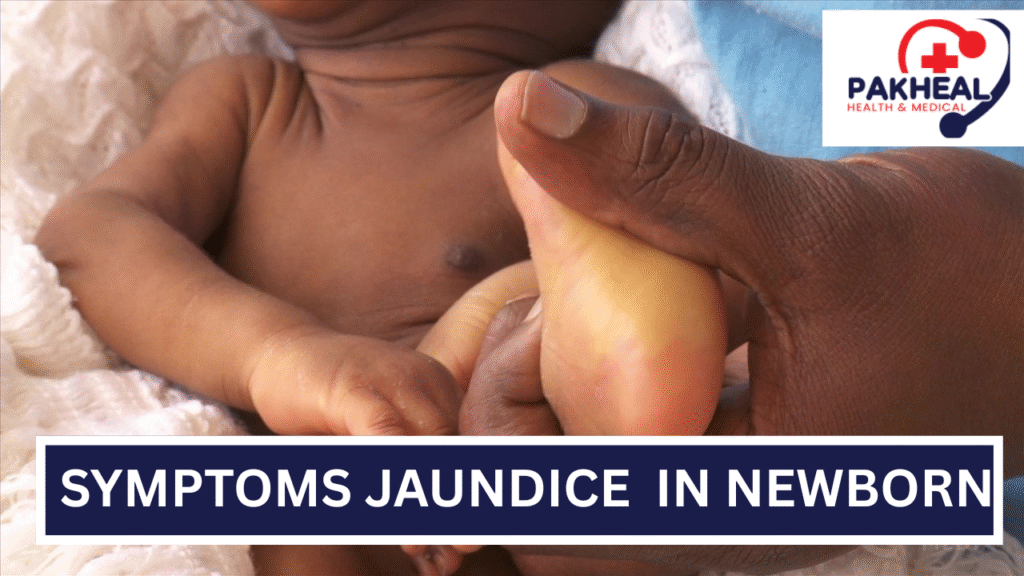 An image of jaundice symptoms occurring in newborn babies